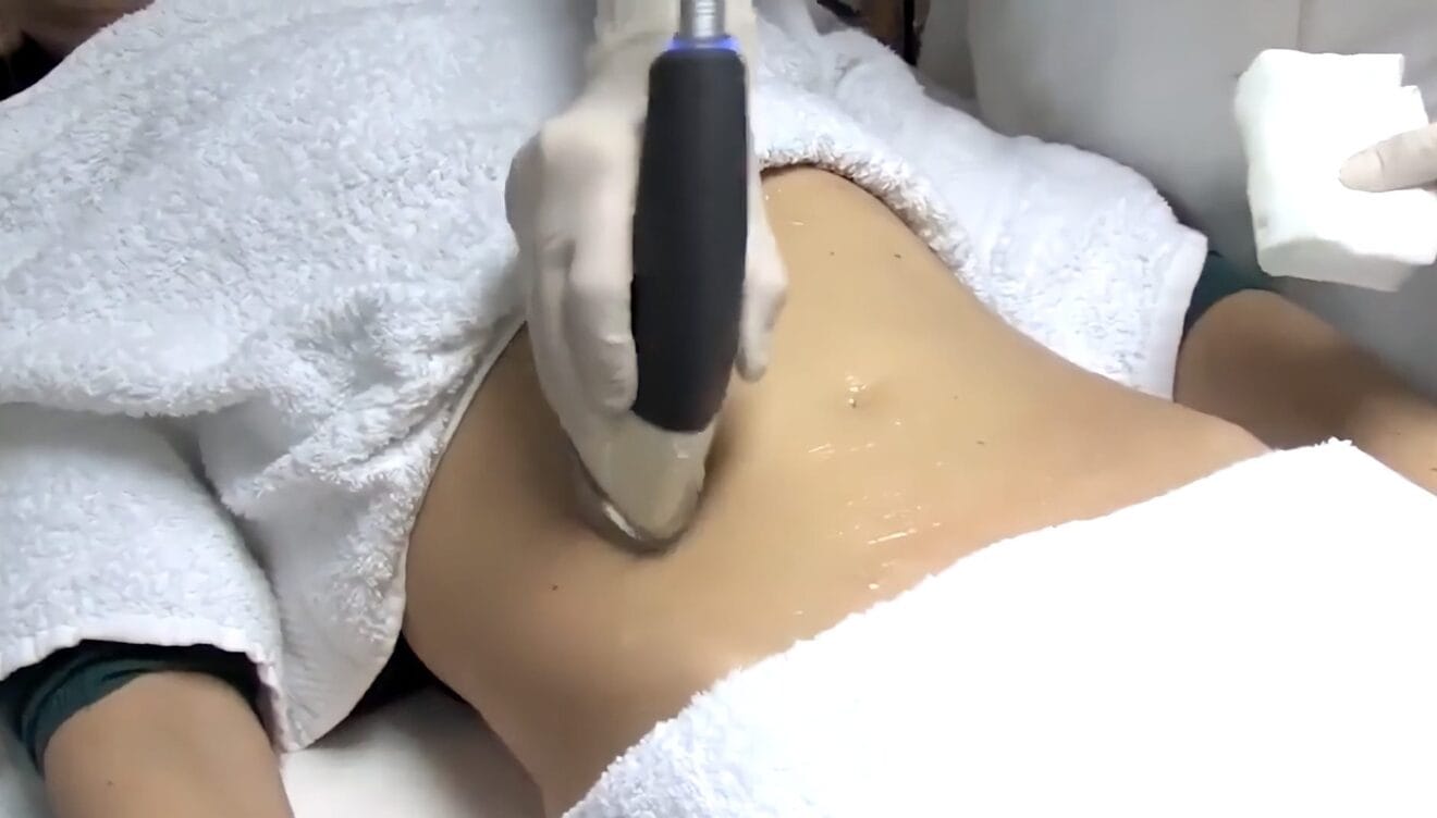 Elimina la grasa más rebelde con el tratamiento Imperium med 400