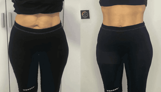 antes y despues del metodo wonder clinica estetica castelblanque