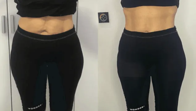 antes y despues del metodo wonder clinica estetica castelblanque