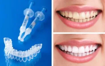 Blanqueamiento dental en casa – Clínica Almidental