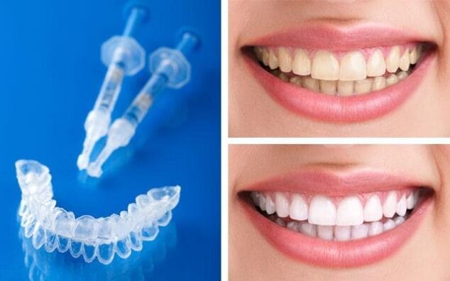 Imagen: Blanqueamiento dental en casa - Clínica Almidental