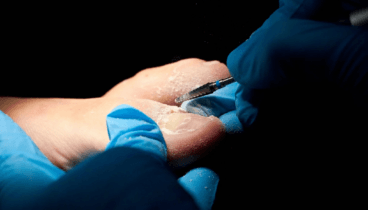 Solución rápida para el dolor de uñas encarnadas en el pie (3)