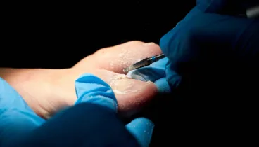 Solución rápida para el dolor de uñas encarnadas en el pie (3)