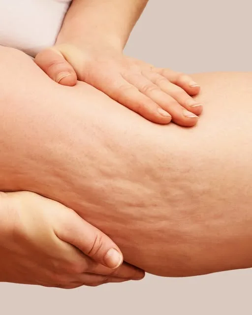 tratamiento eficaz para la eliminacion de celulitis y grasa localizada
