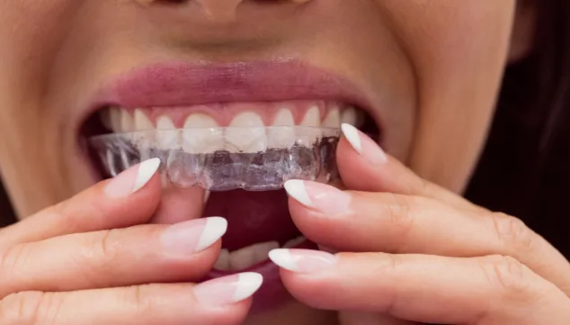 Olvídate de los brackets y consigue una sonrisa perfecta con esta ortodoncia invisible 2 Imagen: Invisalign es un tratamiento de ortodoncia diferente al resto