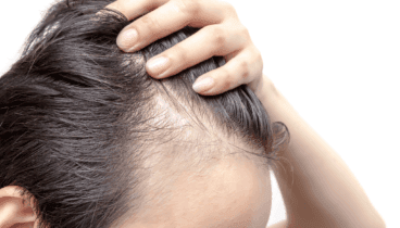 encuentra tu aliado contra la alopecia