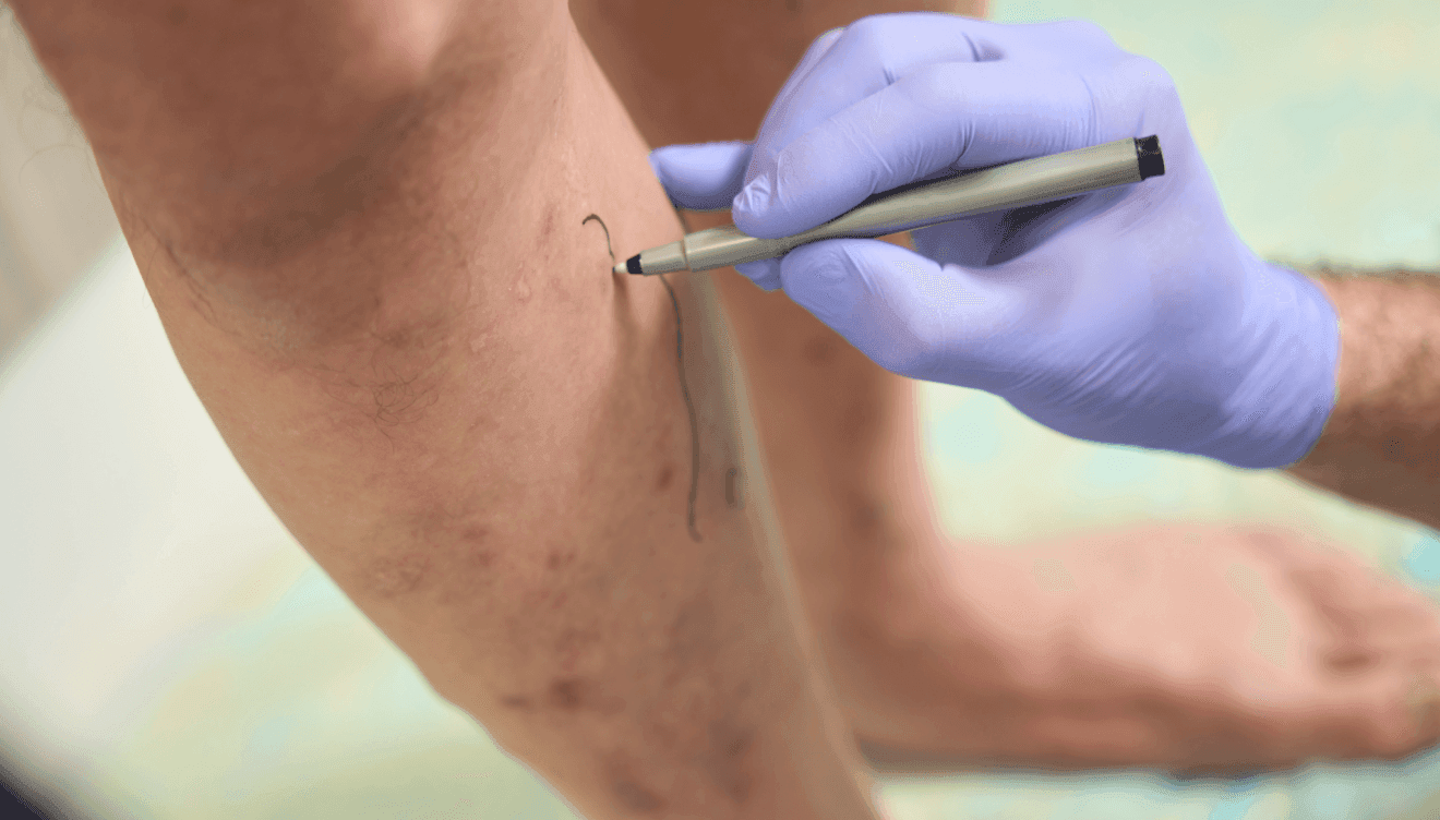 Conoce cuáles son los síntomas de las varices
