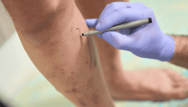 Conoce cuáles son los síntomas de las varices