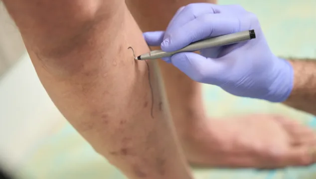 Trata tus varices con los mejores profesionales y luce unas piernas sanas de nuevo 2 Imagen: Conoce cuáles son los síntomas de las varices