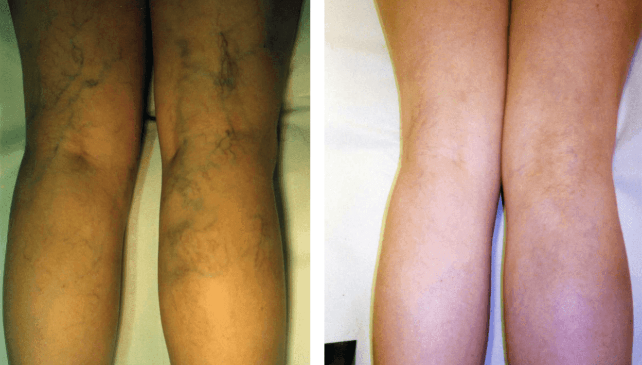 En Policlínica CUME puedes tratar tus varices y ponerles fin