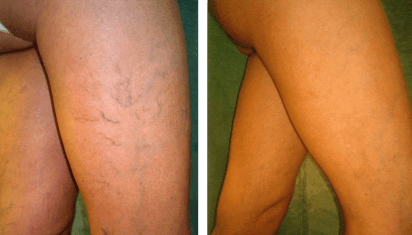 Pon solución a tus varices en Policlínica CUME