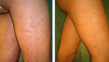 Pon solución a tus varices en Policlínica CUME