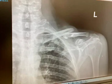 Radiografía de la clavícula rota del ciclista