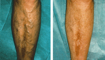 Varices gruesas en piernas