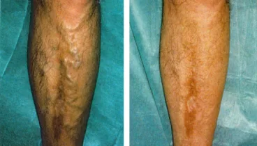 Varices gruesas en piernas