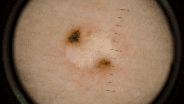 deteccion de lesiones cutaneas benignas y malignas hla san carlos