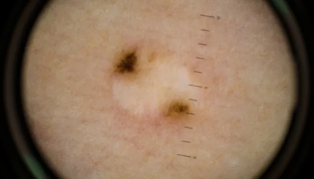 deteccion de lesiones cutaneas benignas y malignas hla san carlos