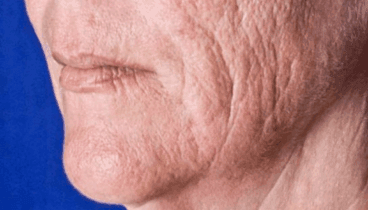 Antes del tratamiento del CO2 fraccional