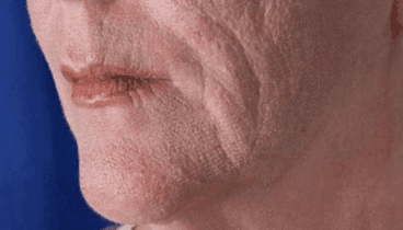 Después del trataiento de CO2 fraccional