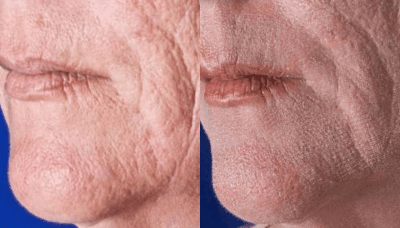 Asi es el láser de CO2 fraccional resultados visibles al instante