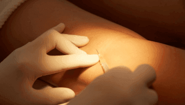 Cómo eliminar tus varices de forma segura y efectiva