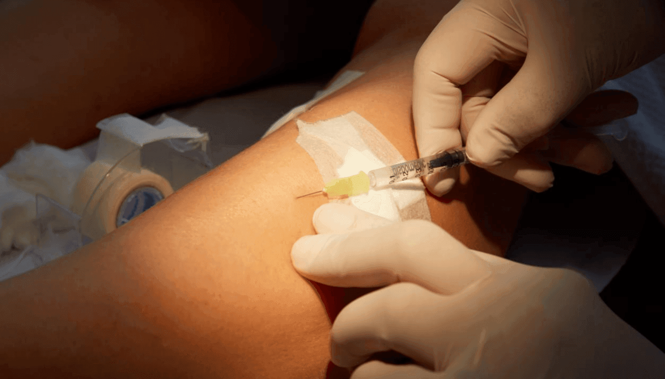 Varices: tratamientos avanzados para piernas saludables