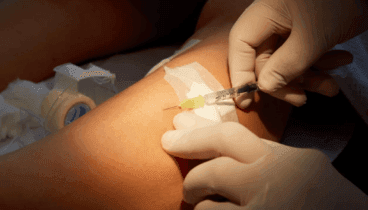 Varices: tratamientos avanzados para piernas saludables