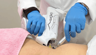 Descubre la Carboxiterapia en la Clínica Flores de Apodaca