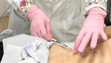 Intralipoterapia tratamiento corporal en la Clínica Flores de Apodaca