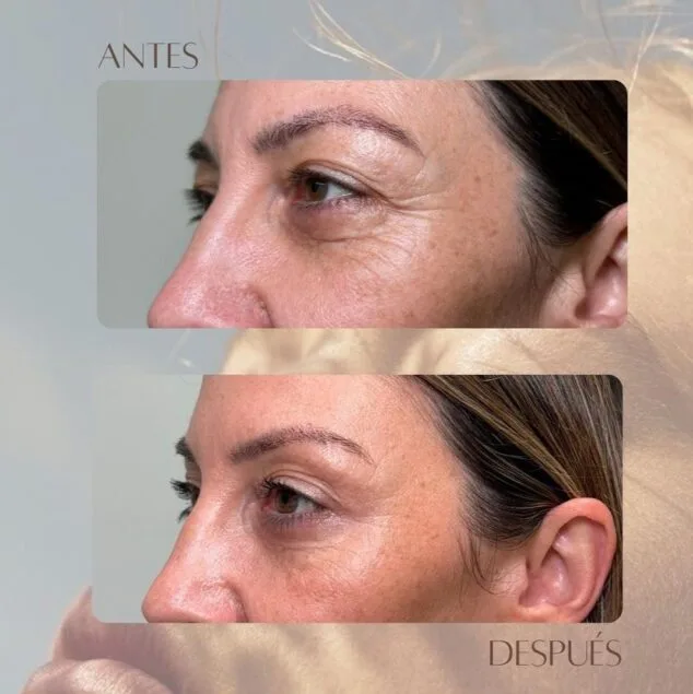 Exosomas y esperma de salmón: la innovación en rejuvenecimiento facial que llega a Dénia 1 Imagen: Antes y después del tratamiento con exosomas y esperma de salmón