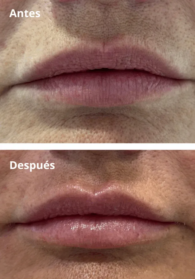 ¿Cómo recuperar la firmeza y el volumen de tu rostro sin cirugía? 13 Imagen: Labios naturales y perfectamente perfilados para realzar tu belleza