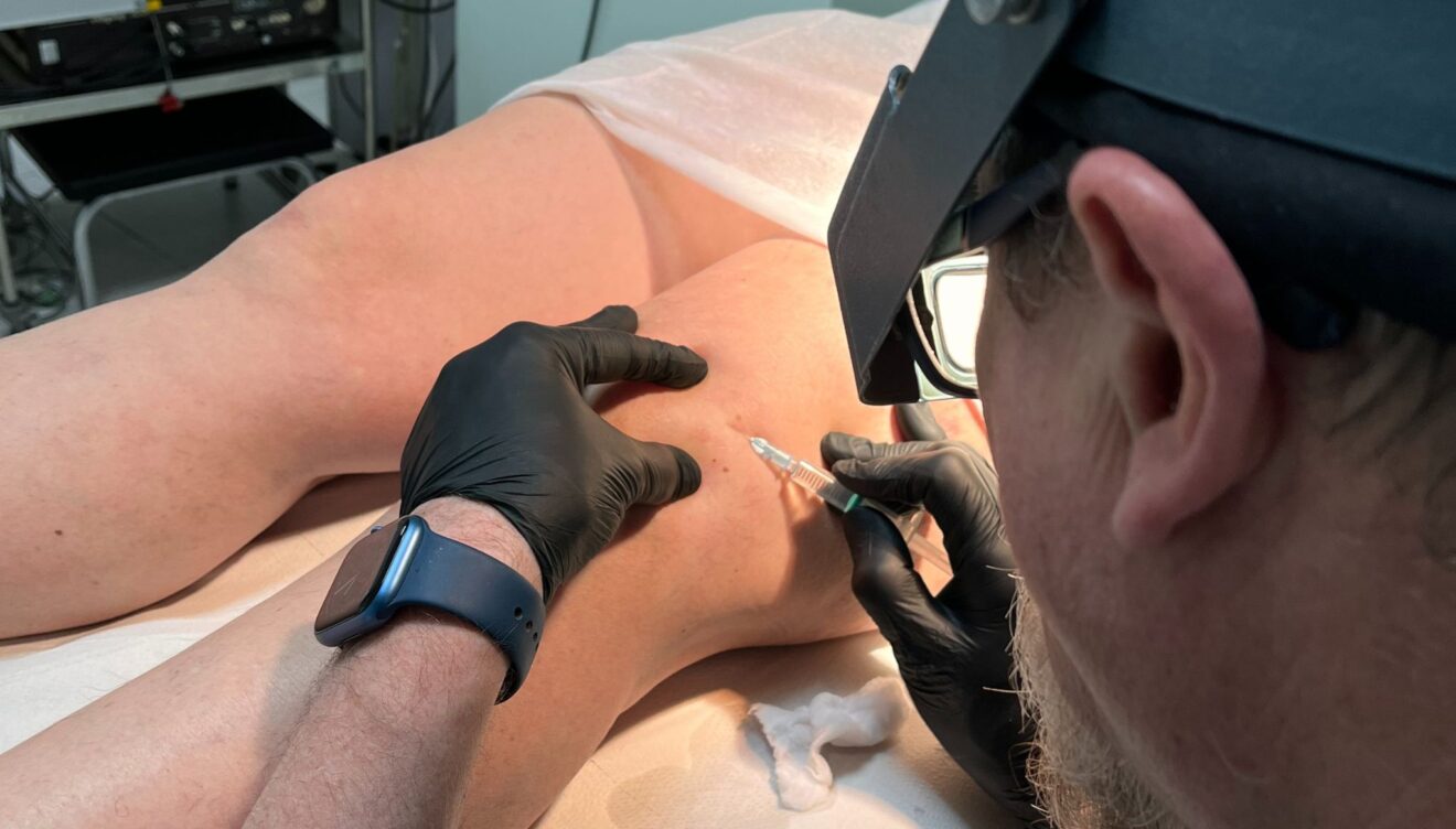 Sichtbare Ergebnisse bei der Beseitigung kleiner Besenreiser