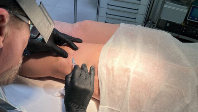 Imagen: Sesión de esclerosis con microespuma para borrar arañas vasculares