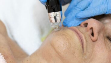 tratamiento de biorevitalizacion en policlinica cume