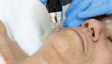tratamiento de biorevitalizacion en policlinica cume