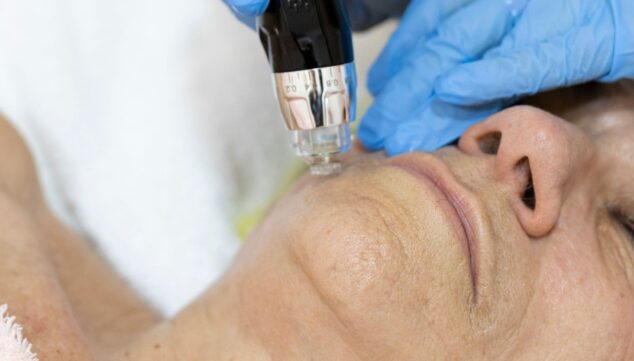 tratamiento de biorevitalizacion en policlinica cume