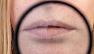 Tratamiento del código de barras labial para suavizar arrugas alrededor de la boca