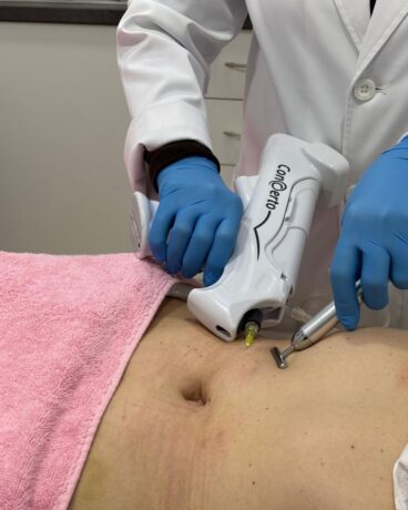 Carboxiterapia, oxigena, disuelve y fuera flacidez