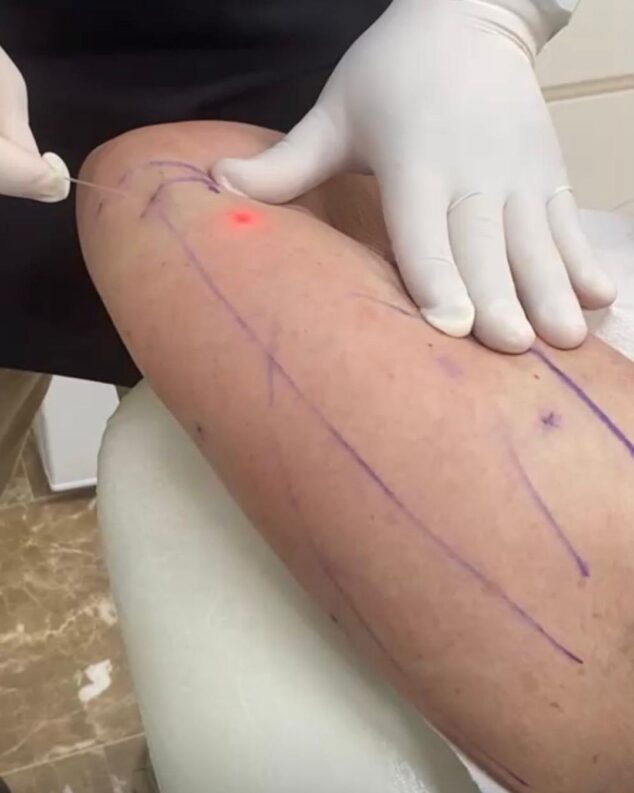 Imagen: Endolift, el nuevo tratamiento de la clínica