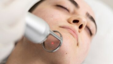 Tratamiento con el láser Q-SWITCHED en Policlínica CUME