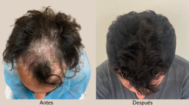 dermadenia apuesta por el trasplante capilar sin rasurar