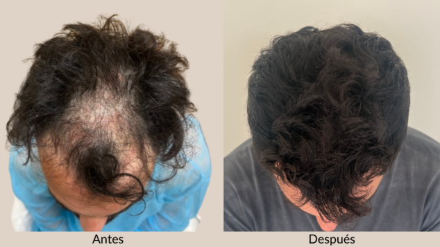 dermadenia apuesta por el trasplante capilar sin rasurar