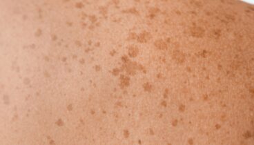Evita las manchas solares