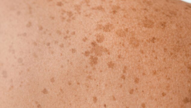 evita las manchas solares