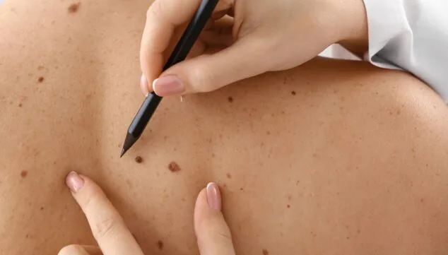 Imagen: HLA San Carlos alerta del aumento del cáncer de piel