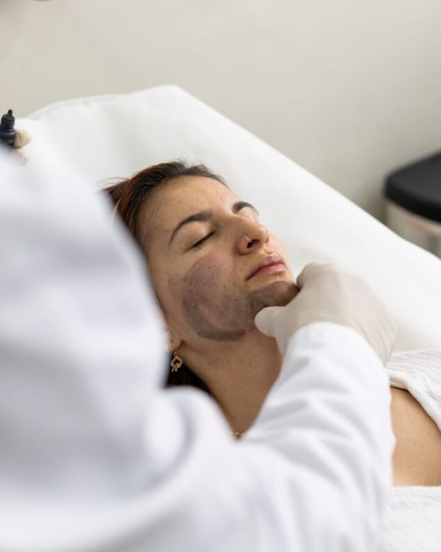 renueva tu rostro con carbon activo y laser