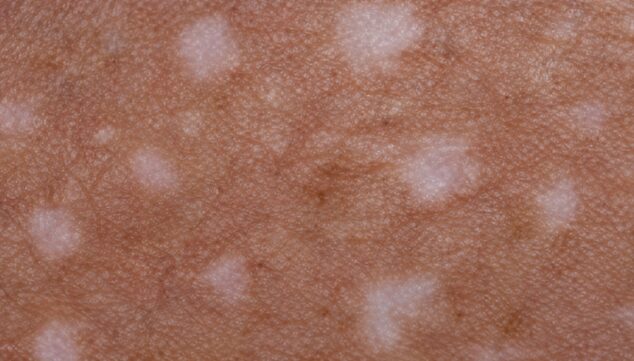 ¿Tienes estas manchas en la piel? El sol podría ser la causa 9 Imagen: Estrategias efectivas para proteger y cuidar la piel